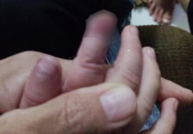 TRAGÉDIA NA CRECHE: BEBÊ TEM DEDO ESMAGADO EM ARMÁRIO E PRECISA PASSAR POR AMPUTAÇÃO EM TAUBATÉ