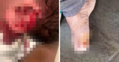 Criança de 3 anos tem parte da orelha arrancada em ataque brutal de cachorro e avó fica ferida ao tentar salvar o neto