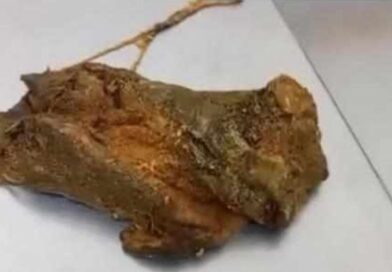 ADOLESCENTE EXPELE GAZE ESQUECIDA APÓS CIRURGIA E FAMÍLIA DENUNCIA POSSÍVEL ERRO MÉDICO EM CAÇAPAVA