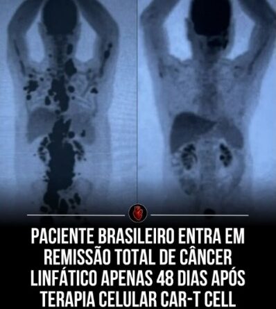CÂNCER DESAPARECE APÓS 48 DIAS DE TERAPIA BRASILEIRA E CASO VIRA SÍMBOLO DE ESPERANÇA CONTRA A DOENÇA