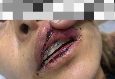 MADRUGADA DE VIOLÊNCIA: FAMÍLIA PEDE JUSTIÇA APÓS MULHER SER AGREDIDA PELO COMPANHEIRO EM VOLTA REDONDA